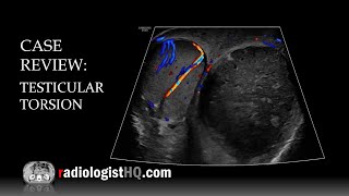 Case Review Ultrasound of Testicular Torsion [upl. by Nelyak]