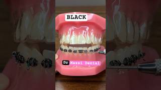 BLACK or PINK Braces 😁 [upl. by Zorina]