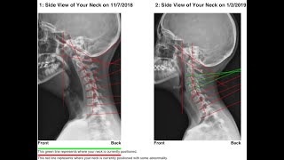 How To Correct Forward Head Posture and Cervical Lordosis With The Cervical Vibratory Traction [upl. by Inacana949]