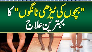 Bacho Ki Tangon Mein Terhapan  Bow Legs Symptoms amp Treatment  How to Fix Childrens Rickets Legs [upl. by Trinetta732]