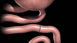 RouxenY gastric bypass animation from wwwhawaiiweightlosscom [upl. by Rodolph231]