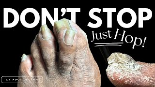 Dont Stop Just Hop Trimming Fungal Toenails [upl. by Nehttam]