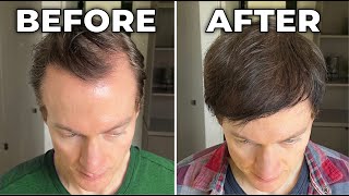 How I Reversed My Hair Loss  Greying [upl. by Ednew]