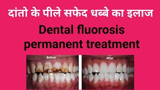 दांतों के पीले सफेद धब्बे का पारमेंट इलाज Dental fluorosis treatment  पीले दांतो का इलाज [upl. by Eilujna695]