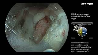 ESD of a LSTNG tumor at the splenic flexure using HYBRIDknife® flex IType [upl. by Amie524]