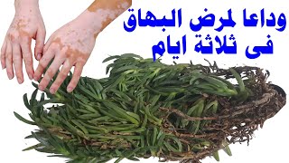 وداعا لمرض البهاق فى ثلاثة ايام وعن تجربة [upl. by Godiva]