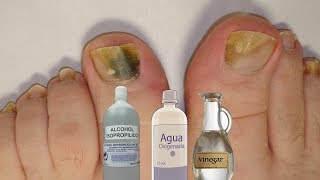 Fabrica tu propio “rompe hongos” natural para las uñas [upl. by Asp]