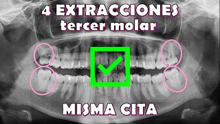 Terceros molares misma cita  Third molars single appointment tercermolar wisdomteeth [upl. by Uhayile216]