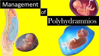 Management of Polyhydramnios [upl. by Naamana]