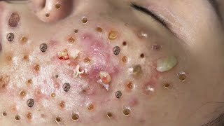 Loan Nguyen Acne Treatment 7d [upl. by Damien]