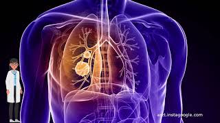 Die Rolle der Bestrahlung bei der Behandlung von Lungenkrebs [upl. by Watt]