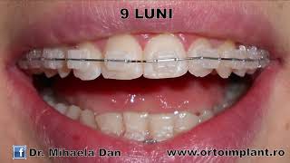 Aparat dentar Fix Ceramic Adulti  rezultat in 15 luni [upl. by Alcock934]