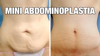 Mini Abdominoplastia antes y después  Testimonio Cristina [upl. by Peggie]