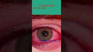 Conjunctivitis  Eye Flu  Conjunctivitis symptoms  viral conjunctivitis  Hindi me [upl. by Earvin]