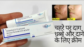 Epiduo Gel Acne Treatment Gel Reduce Acne [upl. by Jorin807]