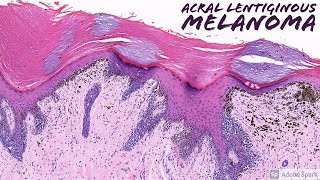 Acral Lentiginous Melanoma Dermatopathology [upl. by Benny851]