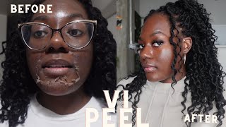 I got a VI chemical peel  7 day chemical peel processVI Peel on Dark skin 🩷 [upl. by Frager]