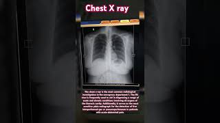 x ray of chest PA view  33 years old female kgf anatomy xray hospital radiology doctor [upl. by Kcirdahs]