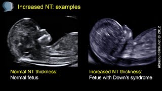 Nuchal translucency NT [upl. by Kcam]