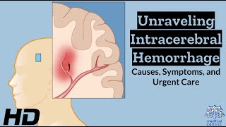 Intracerebral Hemorrhage Unveiled Understanding the Whys Whats and Hows [upl. by Mallin360]