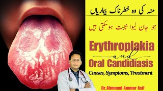 What Is Erythroplakia amp Oral Candidiasis  Causes Symptoms Treatment [upl. by Ettecul546]