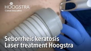 Seborrheic Keratosis  Laser treatment Hoogstra  22135 [upl. by Der589]