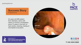 Polypectomy for 55 years male suffering with chronic constipation since 10 years PaceHospitals [upl. by Jaclin]