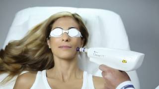 ClearLift  Laser Treatment [upl. by Keever]