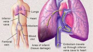 Pulmonary Embolism [upl. by Meijer]