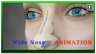 Rhinoplasty Animation  How can a Wide nose be narrowed [upl. by Nemhauser]