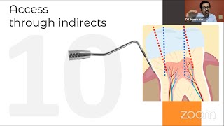 ACCESS OPENING in ROOT CANAL TREATMENT  Clinical Tips and Tricks [upl. by Ert]