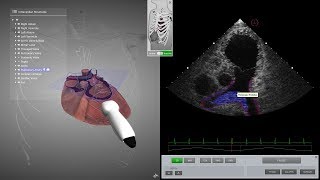 HeartWorks Pulmonary Embolism [upl. by Barayon]