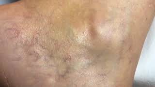 Sclerotherapy Treatment of our Bulgarian Patient [upl. by Jeramie]