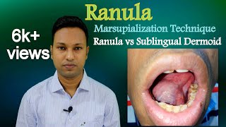 Ranula। How to Marsupialize। Ranula vs Sublingual Dermoid [upl. by Lail]