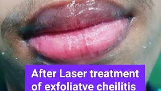 Two cases of exfoliatve cheilitis treated by Laser excellent response [upl. by Eduino981]