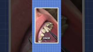 O segredo dos dentes de soldados 🦷 curiosidades fatos shorts [upl. by Diarmuid]