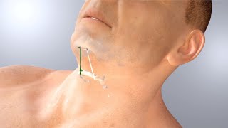 AIRLIFT Hyoid Suspension animation [upl. by Rebmat]