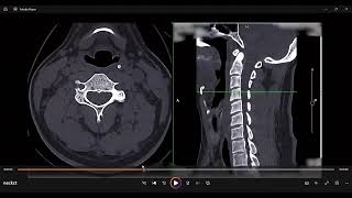 aryepiglottic folds neck CT anatomy think of cobra fangs [upl. by Wollis481]