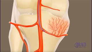 Genicular Artery Embolization for Osteoarthritis [upl. by Hanser424]