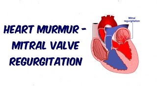 Mitral Regurgitation  Auscultation Sound [upl. by Clere421]