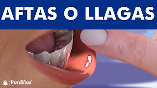 LLAGAS en la BOCA 😩 Conoce por qué SALEN y Cómo se CURAN 3 Tipos ⛑ [upl. by Galina]