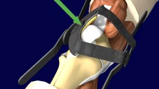 PTO Patellar Tracking Orthosis Knee Brace Directions and Application [upl. by Sonny]