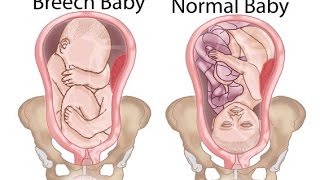 Breech Baby Treatment [upl. by Wohlert]