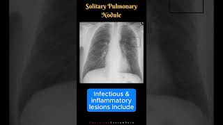 Solitary Pulmonary Nodules Mass like Lesions Differential Diagnosis shorts [upl. by Brandenburg]