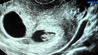 8 week ultrasound TWINS with heartbeats IVF [upl. by Sharl]