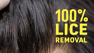 Get Rid Of Lice COMPLETELY  Safe amp Natural Home Remedies For Lice amp Nits [upl. by Ynnhoj]