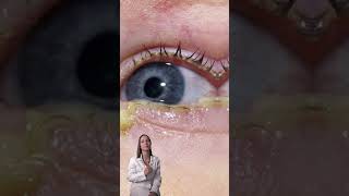 CONJUNTIVITIS BACTERIANA saludocular cuidadodelosojos doctora [upl. by Azila]