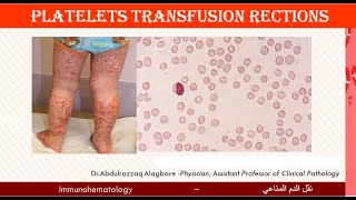 Lecture 218 Platelets Transfusion Reactions [upl. by Yerag]