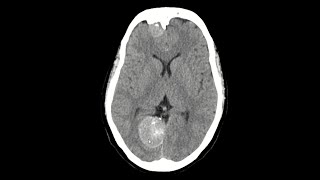 Falx meningioma MRI brain [upl. by Esenaj]