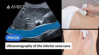 Point of Care Ultrasound of the Inferior Vena Cava IVC  AMBOSS Video [upl. by Debo326]